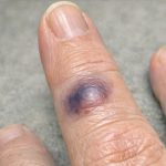 Mom Woke Up With This Sudden Dark Purple Bruise Bulging Under Her Finger. She Says It Stings, but the Clinic Is Closed Today. Is This Serious?