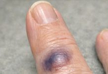 Mom Woke Up With This Sudden Dark Purple Bruise Bulging Under Her Finger. She Says It Stings, but the Clinic Is Closed Today. Is This Serious?