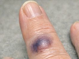 Mom Woke Up With This Sudden Dark Purple Bruise Bulging Under Her Finger. She Says It Stings, but the Clinic Is Closed Today. Is This Serious?