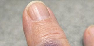 Mom Woke Up With This Sudden Dark Purple Bruise Bulging Under Her Finger. She Says It Stings, but the Clinic Is Closed Today. Is This Serious?