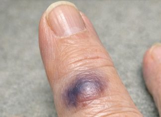 Mom Woke Up With This Sudden Dark Purple Bruise Bulging Under Her Finger. She Says It Stings, but the Clinic Is Closed Today. Is This Serious?