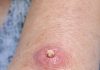Mom Has This Fast-Growing, Dome-Shaped Pink Bump With a Hard Plug in the Center on Her Forearm. The Clinic Is Closed for the Weekend. What Is This?
