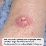 Mom Has This Fast-Growing, Dome-Shaped Pink Bump With a Hard Plug in the Center on Her Forearm. The Clinic Is Closed for the Weekend. What Is This?