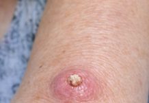Mom Has This Fast-Growing, Dome-Shaped Pink Bump With a Hard Plug in the Center on Her Forearm. The Clinic Is Closed for the Weekend. What Is This?