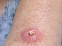 Mom Has This Fast-Growing, Dome-Shaped Pink Bump With a Hard Plug in the Center on Her Forearm. The Clinic Is Closed for the Weekend. What Is This?