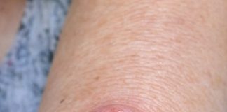 Mom Has This Fast-Growing, Dome-Shaped Pink Bump With a Hard Plug in the Center on Her Forearm. The Clinic Is Closed for the Weekend. What Is This?