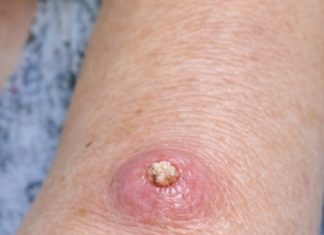 Mom Has This Fast-Growing, Dome-Shaped Pink Bump With a Hard Plug in the Center on Her Forearm. The Clinic Is Closed for the Weekend. What Is This?