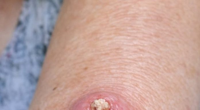 Mom Has This Fast-Growing, Dome-Shaped Pink Bump With a Hard Plug in the Center on Her Forearm. The Clinic Is Closed for the Weekend. What Is This?