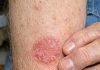 My husband keeps getting this coin shaped red scaly rash on his arms. We are hours from urgent care and he is scratching endlessly. What is this?