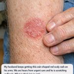 My husband keeps getting this coin shaped red scaly rash on his arms. We are hours from urgent care and he is scratching endlessly. What is this?