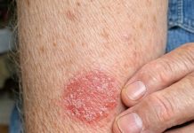 My husband keeps getting this coin shaped red scaly rash on his arms. We are hours from urgent care and he is scratching endlessly. What is this?