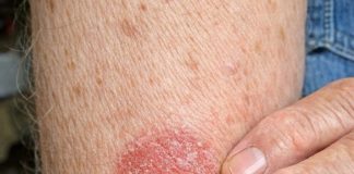 My husband keeps getting this coin shaped red scaly rash on his arms. We are hours from urgent care and he is scratching endlessly. What is this?