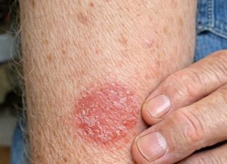 My husband keeps getting this coin shaped red scaly rash on his arms. We are hours from urgent care and he is scratching endlessly. What is this?