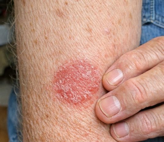 My husband keeps getting this coin shaped red scaly rash on his arms. We are hours from urgent care and he is scratching endlessly. What is this?