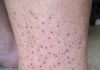 My husband woke up with these tiny flat purple dots spreading all over his lower legs and ankles. We are hours from urgent care. Is this serious?