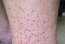 My husband woke up with these tiny flat purple dots spreading all over his lower legs and ankles. We are hours from urgent care. Is this serious?