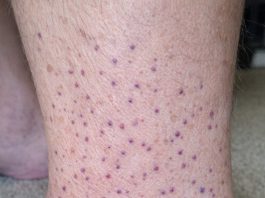 My husband woke up with these tiny flat purple dots spreading all over his lower legs and ankles. We are hours from urgent care. Is this serious?