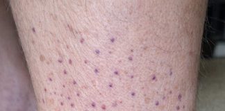 My husband woke up with these tiny flat purple dots spreading all over his lower legs and ankles. We are hours from urgent care. Is this serious?