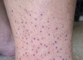 My husband woke up with these tiny flat purple dots spreading all over his lower legs and ankles. We are hours from urgent care. Is this serious?