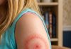 My Daughter Woke Up With a Strange Red Ring on Her Arm: A Parent’s Guide to Ring-Shaped Rashes (And When to Breathe Easy)