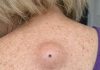 Mom woke up with this smooth round lump under the skin on her upper back with a tiny dark dot in the center. ER wait is 8 hours. What is this?