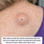 Mom woke up with this smooth round lump under the skin on her upper back with a tiny dark dot in the center. ER wait is 8 hours. What is this?