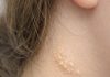 My teenage daughter keeps getting these soft yellowish pebbly bumps like plucked chicken skin on the side of her neck. What is this?