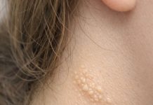 My teenage daughter keeps getting these soft yellowish pebbly bumps like plucked chicken skin on the side of her neck. What is this?