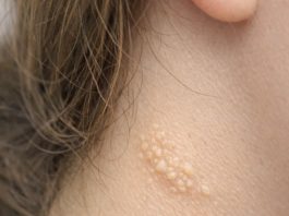 My teenage daughter keeps getting these soft yellowish pebbly bumps like plucked chicken skin on the side of her neck. What is this?