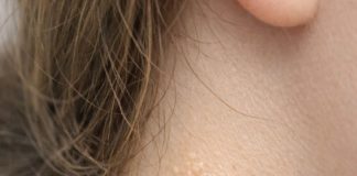 My teenage daughter keeps getting these soft yellowish pebbly bumps like plucked chicken skin on the side of her neck. What is this?