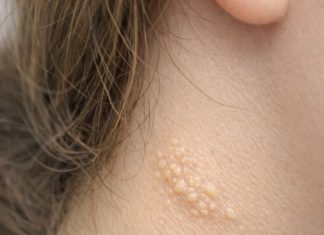 My teenage daughter keeps getting these soft yellowish pebbly bumps like plucked chicken skin on the side of her neck. What is this?