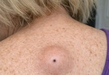 Mom woke up with this smooth round lump under the skin on her upper back with a tiny dark dot in the center. ER wait is 8 hours. What is this?
