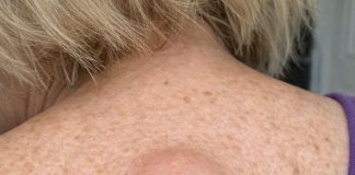 Mom woke up with this smooth round lump under the skin on her upper back with a tiny dark dot in the center. ER wait is 8 hours. What is this?