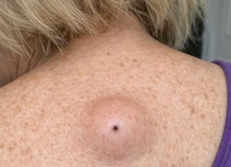 Mom woke up with this smooth round lump under the skin on her upper back with a tiny dark dot in the center. ER wait is 8 hours. What is this?