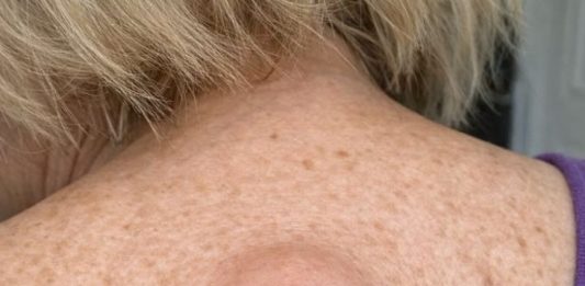 Mom woke up with this smooth round lump under the skin on her upper back with a tiny dark dot in the center. ER wait is 8 hours. What is this?