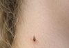 My teenage daughter keeps getting this spiky, thread-like little skin bump growing on her neck. She has a recital tomorrow. What is this?.