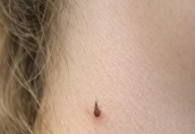 My teenage daughter keeps getting this spiky, thread-like little skin bump growing on her neck. She has a recital tomorrow. What is this?.