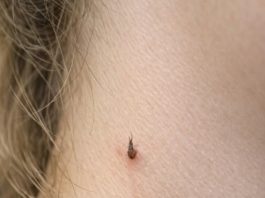 My teenage daughter keeps getting this spiky, thread-like little skin bump growing on her neck. She has a recital tomorrow. What is this?.