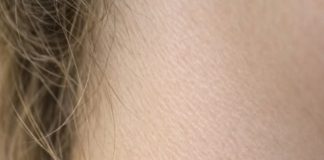 My teenage daughter keeps getting this spiky, thread-like little skin bump growing on her neck. She has a recital tomorrow. What is this?.