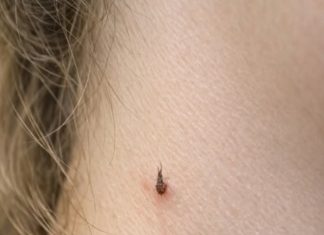 My teenage daughter keeps getting this spiky, thread-like little skin bump growing on her neck. She has a recital tomorrow. What is this?.
