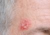 My husband keeps getting this rough, scaly red patch on his temple that feels like sandpaper. The clinic is closed for the weekend. Is this serious?