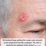 My husband keeps getting this rough, scaly red patch on his temple that feels like sandpaper. The clinic is closed for the weekend. Is this serious?