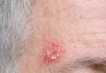 My husband keeps getting this rough, scaly red patch on his temple that feels like sandpaper. The clinic is closed for the weekend. Is this serious?