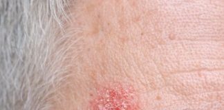My husband keeps getting this rough, scaly red patch on his temple that feels like sandpaper. The clinic is closed for the weekend. Is this serious?
