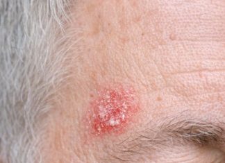 My husband keeps getting this rough, scaly red patch on his temple that feels like sandpaper. The clinic is closed for the weekend. Is this serious?