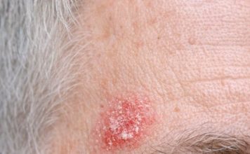 My husband keeps getting this rough, scaly red patch on his temple that feels like sandpaper. The clinic is closed for the weekend. Is this serious?