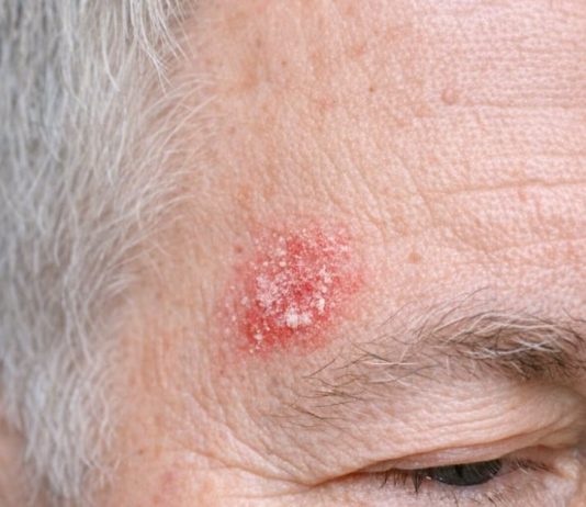 My husband keeps getting this rough, scaly red patch on his temple that feels like sandpaper. The clinic is closed for the weekend. Is this serious?