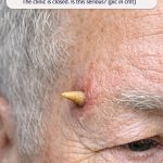 My grandfather keeps getting this hard, yellowish spike sticking straight out of his temple like a tiny horn. The clinic is closed. Is this serious?