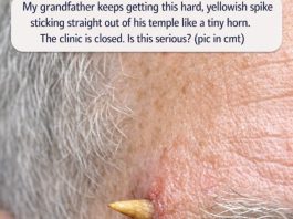 My grandfather keeps getting this hard, yellowish spike sticking straight out of his temple like a tiny horn. The clinic is closed. Is this serious?