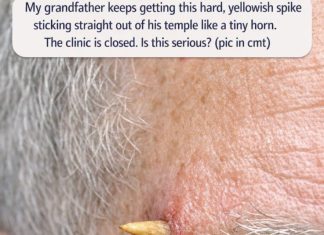 My grandfather keeps getting this hard, yellowish spike sticking straight out of his temple like a tiny horn. The clinic is closed. Is this serious?
